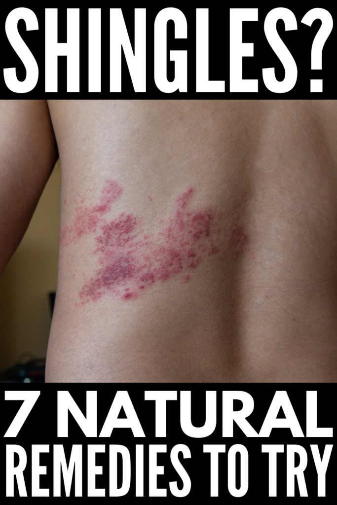 Itchy Shingles Rash Treatment At Christina Coleman Blog